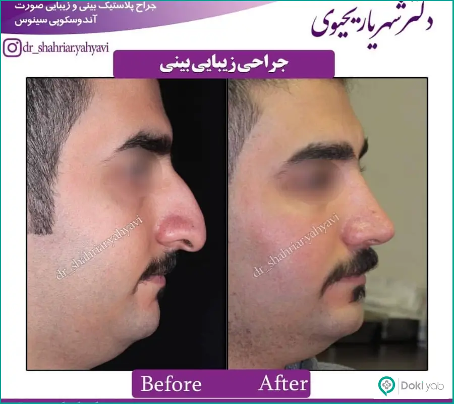نمونه عمل جراحی بینی مردانه دکتر شهریار یحیوی