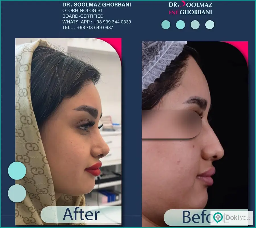 نمونه قبل و بعد عمل جراحی دماغ دکتر سولماز قربانی در شیراز