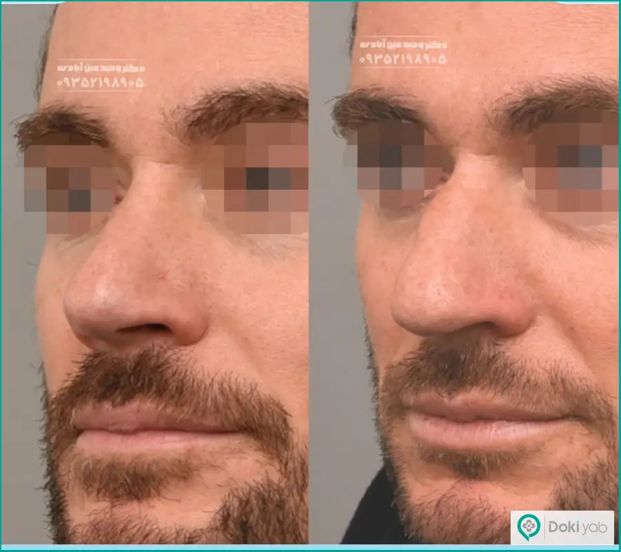 نمونه کار قبل و بعد عمل زیبایی بینی مردانه دکتر وحید عین آبادی