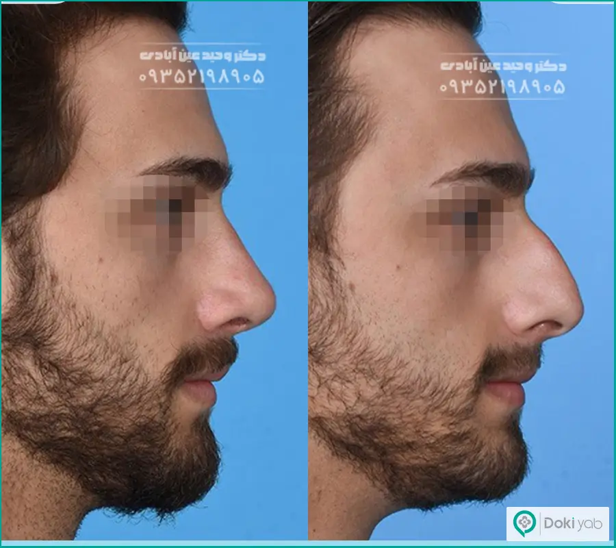 قبل و بعد جراحی بینی مردانه بزرگ دکتر وحید عین آبادی