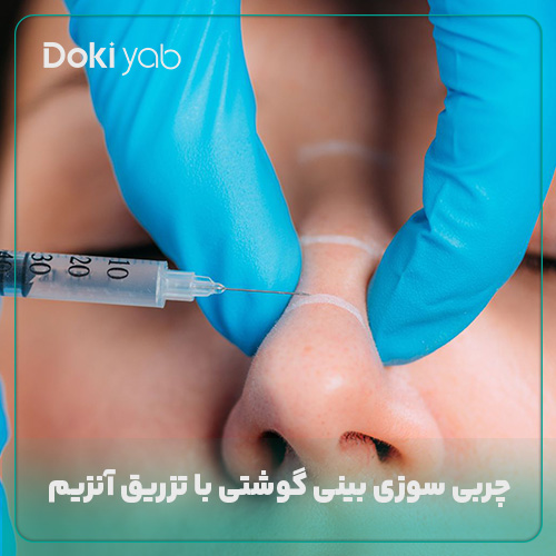 تزریق آنزیم برای کاهش  سایز بینی گوشتی