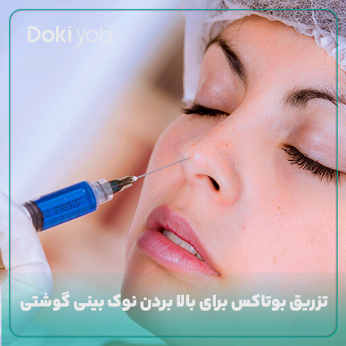 تزریق بوتاکس برای بالا بردن نوک بینی گوشتی
