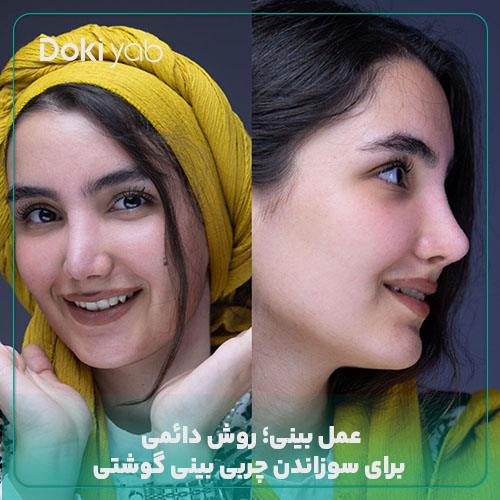 جراحی برای فرم دهی و چربی سوزی بینی گوشتی
