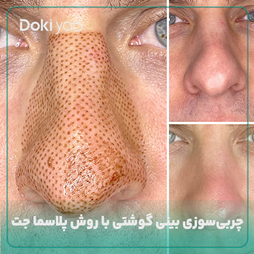 چربی سوزی بینی گوشتی با روش پلاسما جت