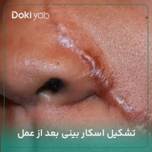 عکس گوشت اضافه بینی بعد از جراحی؛ مجله دکی یاب