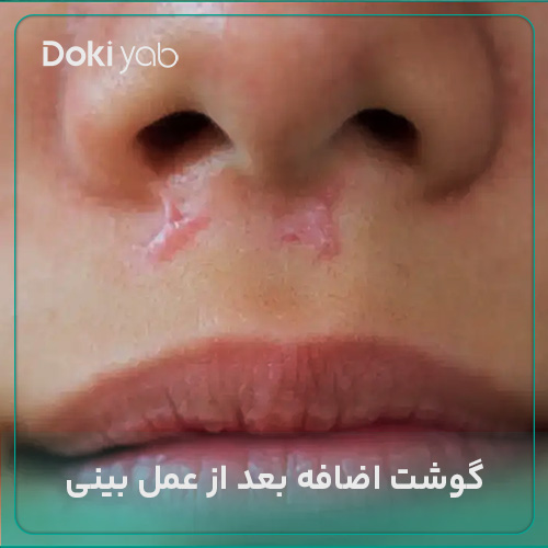 بررسی دلیل تشکیل گوشت اضافه بعد از عمل بینی در دکی یاب