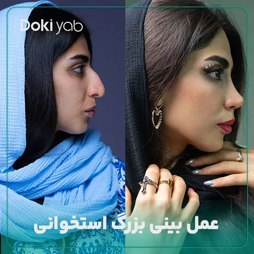 عمل بینی بزرگ استخوانی