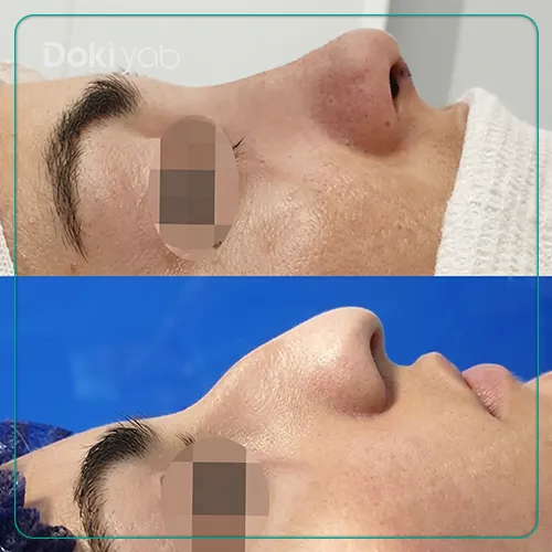 جراحی زیبایی بینی استخوانی بزرگ دکتر ده بزرگی