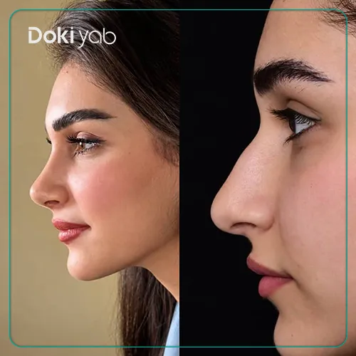 جراحی بینی استخوانی بزرگ دکتر حمیدرضا راستی 
