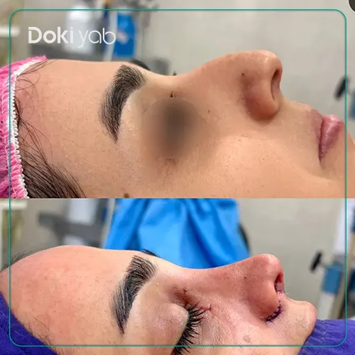 نمونه کار جراحی بینی استخوانی بزرگ دکتر حسین کرم‌نژاد در شیراز