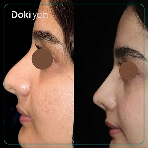جراحی زیبایی بینی استخوانی بزرگ دکتر عمرانی فرد 