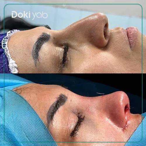 عمل بینی بزرگ استخوانی دکتر نیلوفر رحیمی پور