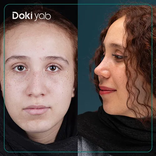 قبل و بعد عمل بینی استخوانی بزرگ دکتر امید زرگرانی