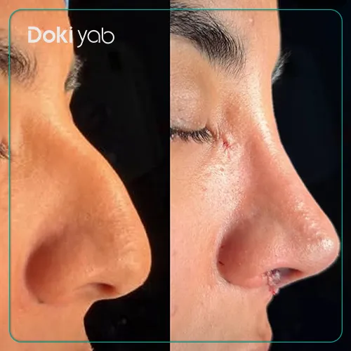 نمونه کار عمل بینی بزرگ استخوانی دکتر وحیده موسوی