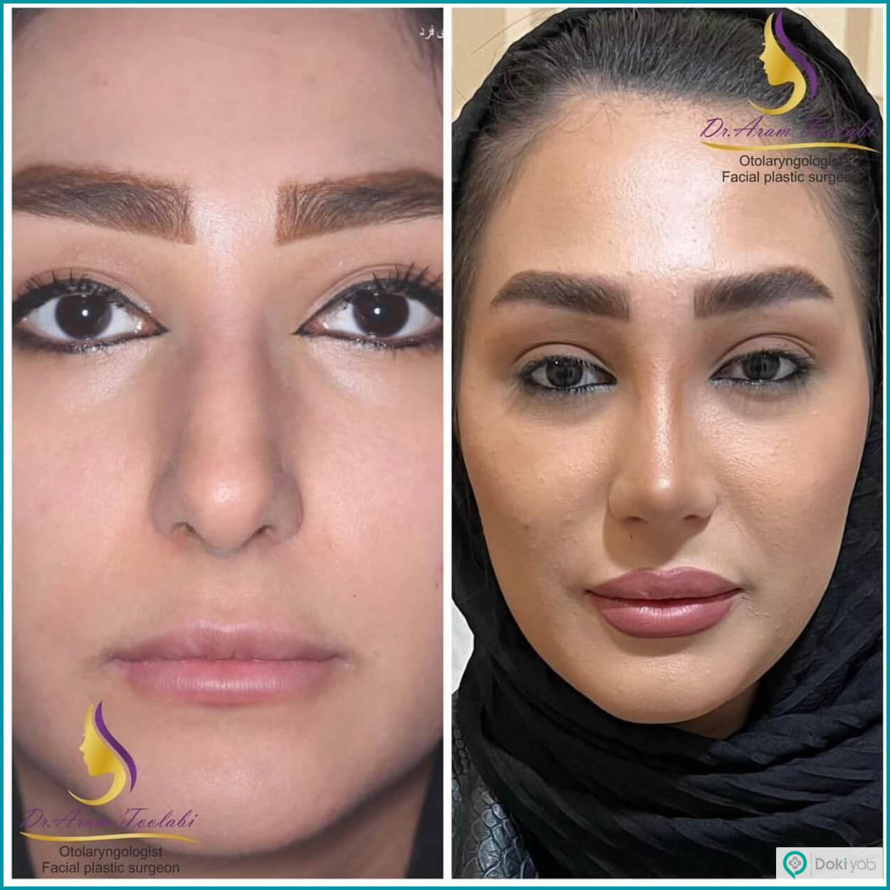 نمونه جراحی بینی با دکتر آرام طولابی، جراح بینی در لرستان