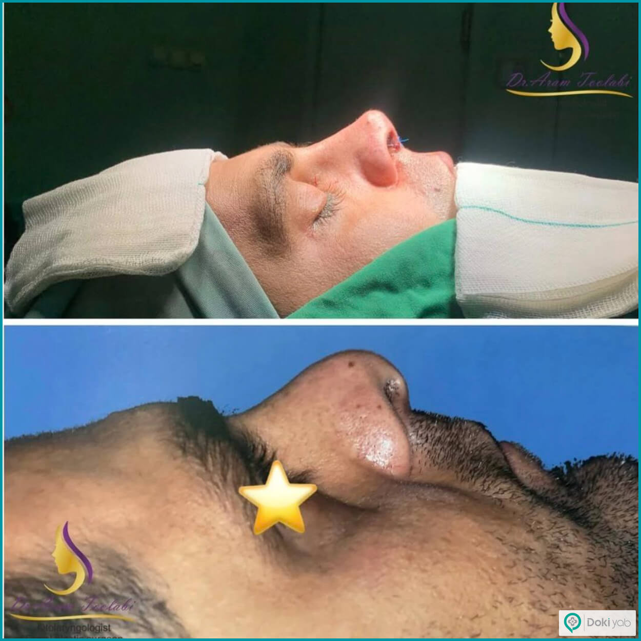 نمونه جراحی بینی با دکتر آرام طولابی، جراح بینی در لرستان