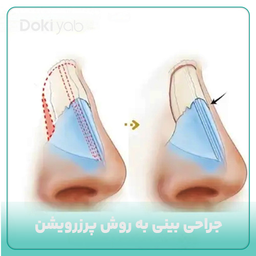 جراحی بینی پرزرویشن چیست؟ مجله دکی یاب