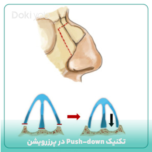 تکنیک Push-down در عمل بینی به روش پرزرویشن