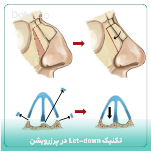 تکنیک Let-down در عمل بینی پرزرویشن