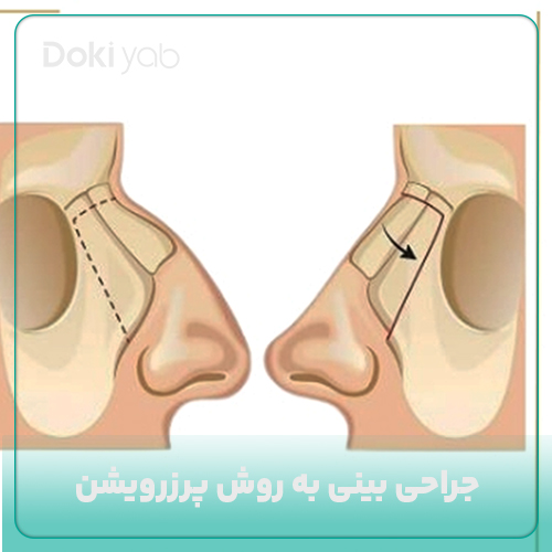 جراحی بینی به روش پرزرویشن؛ مجله دکی یاب