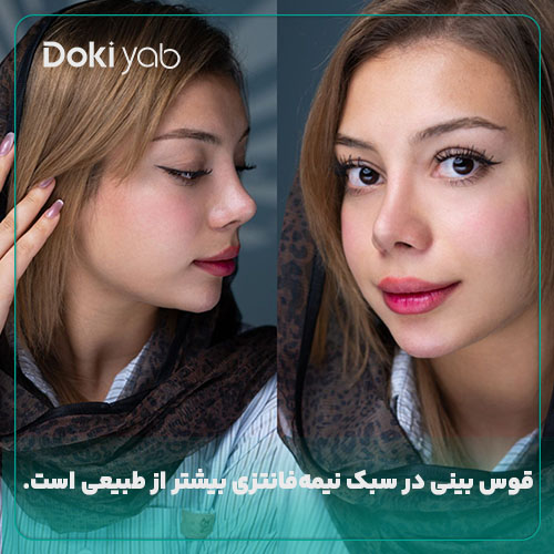 بررسی تفاوت بینی طبیعی و نیمه فانتزی در میزان قوس بینی