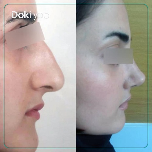 جراحی بینی زنانه دکتر شفائی خانقاه