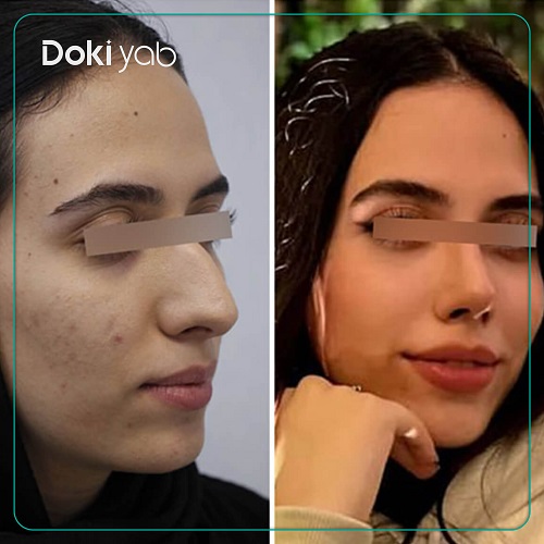 عمل بینی زنانه دکتر یوسف شفائی خانقاه