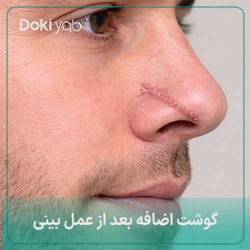 عکس گوشت اضافه بینی بعد از عمل؛ مجله دکی یاب