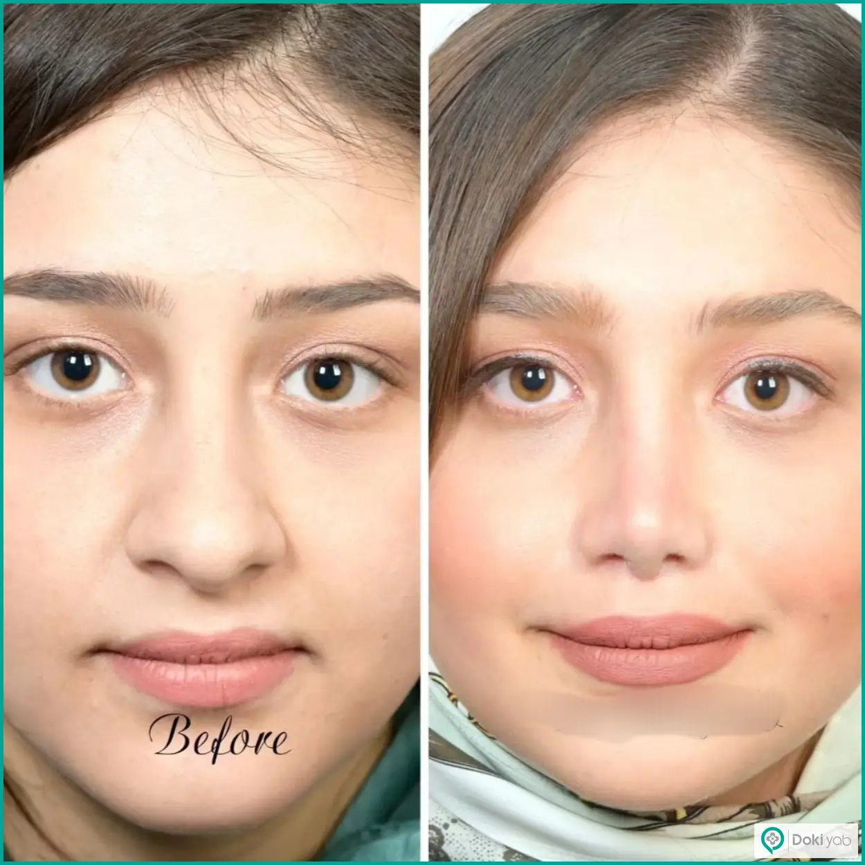 تصویر قبل و بعد عمل بینی نیمه فانتزی دکتر حسین دستغیب