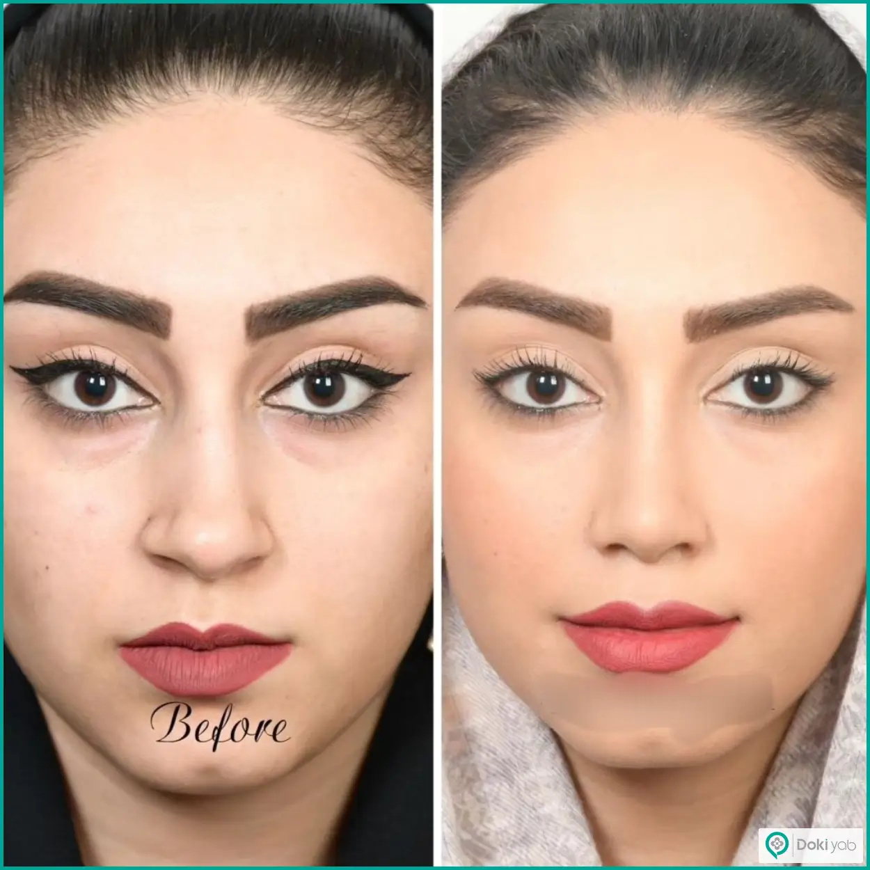 تصویر قبل و بعد عمل بینی استخوانی دکتر حسین دستغیب