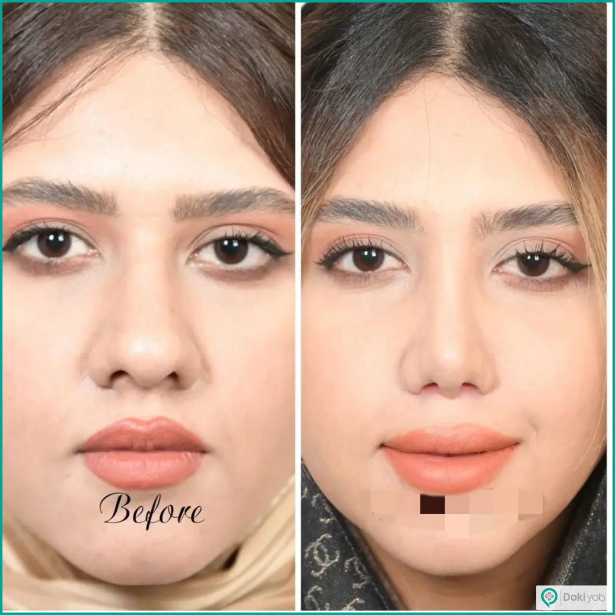 تصویر قبل و بعد جراحی بینی گوشتی دکتر حسین دستغیب