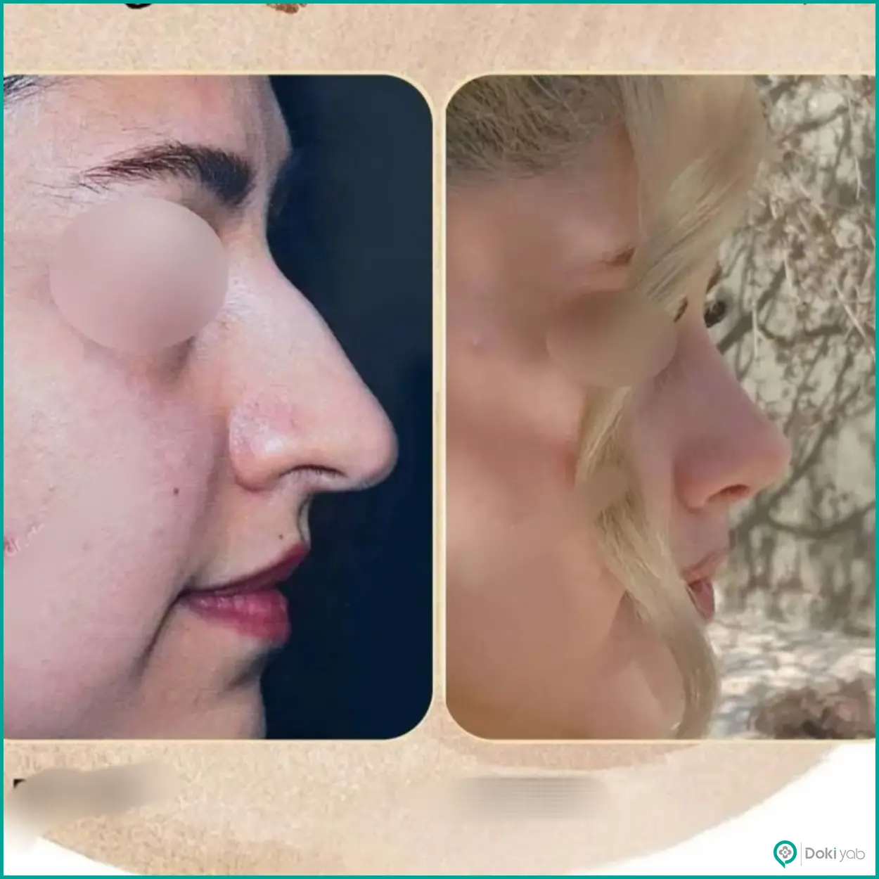 تصویر قبل و بعد عمل بینی استخوانی دکتر دنیا کرمی