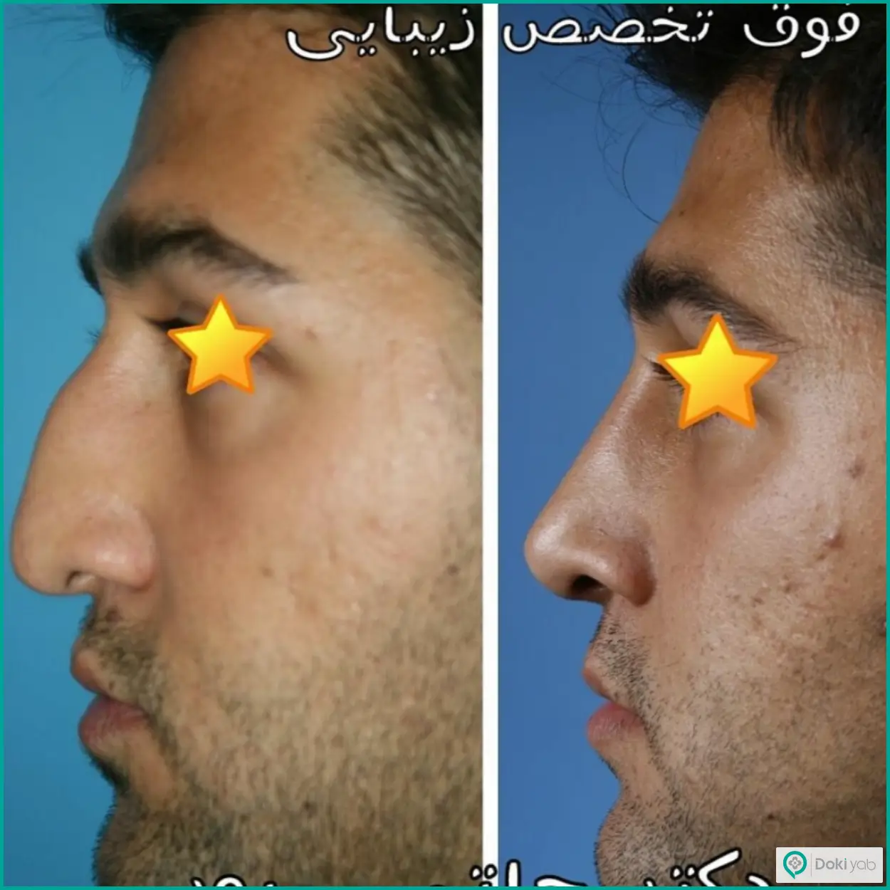 عکس قبل و بعد عمل بینی به سبک طبیعی مردانه دکتر ابراهیم حاتمی پور در شیراز