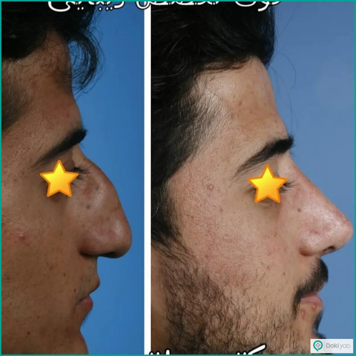 عکس قبل و بعد عمل بینی به سبک طبیعی دکتر ابراهیم حاتمی پور جراح بینی در شیراز