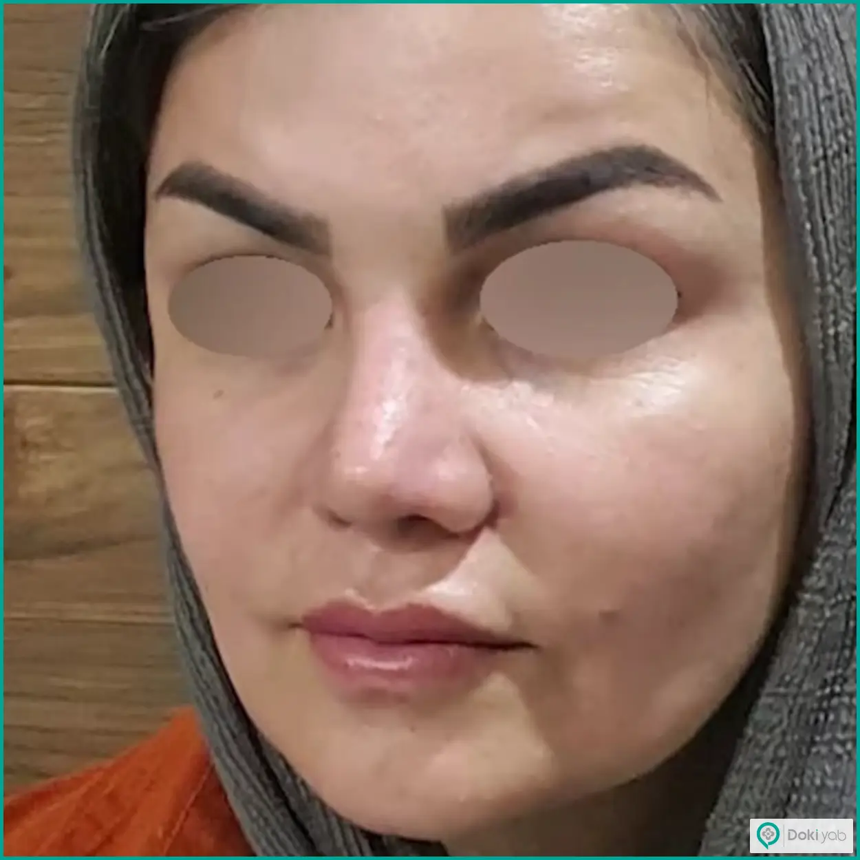 نمونه جراحی بینی طبیعی دکتر رضا کبودخانی جراح بینی در شیراز