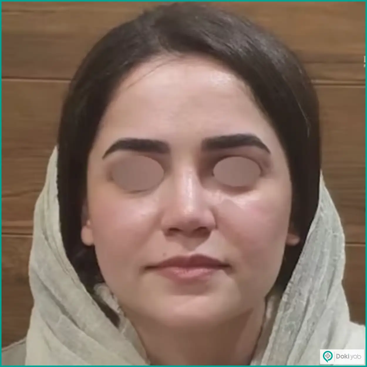 نمونه عمل زیبایی بینی طبیعی دکتر رضا کبودخانی جراح بینی در شیراز