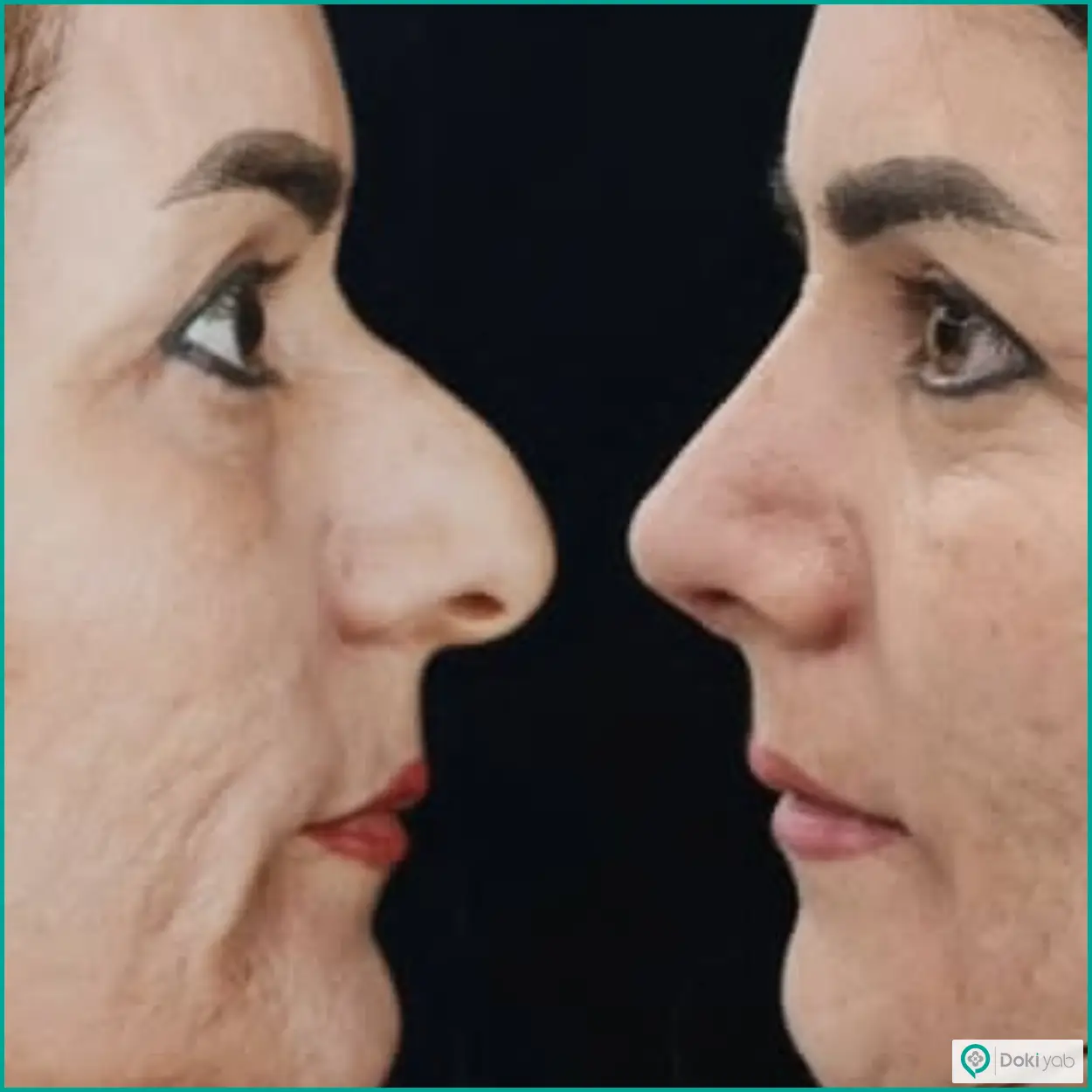 تصویر قبل و بعد عمل بینی طبیعی دکتر لیلا شریفی