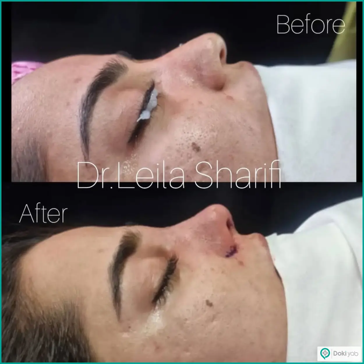تصویر قبل و بعد جراحی بینی طبیعی دکتر لیلا شریفی
