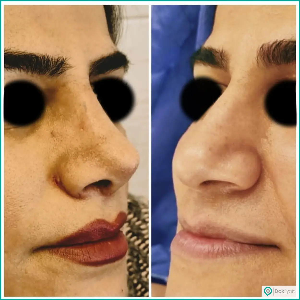تصویر قبل و بعد جراحی بینی طبیعی دکتر حشمت الله حقوقی