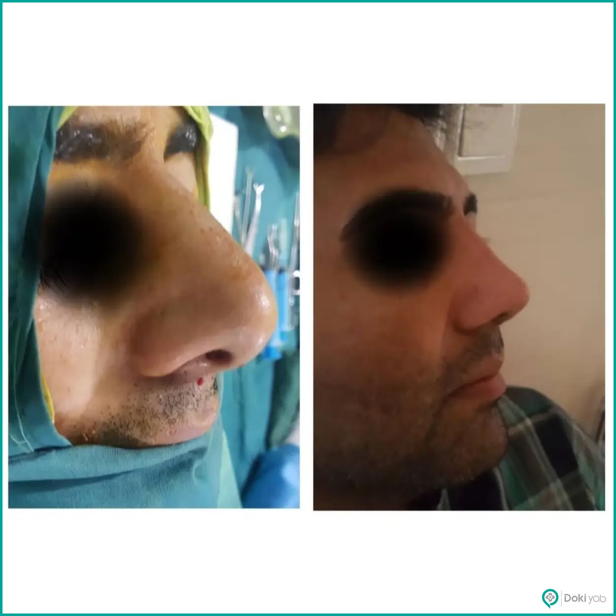 نمونه جراحی بینی طبیعی دکتر حشمت الله حقوقی