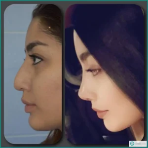 نمونه عمل بینی نیمه فانتزی دکتر فیروزه یگانه