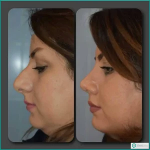 نمونه عمل بینی گوشتی نیمه فانتزی دکتر فیروزه یگانه