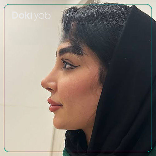 نمونه کار جراحی بینی عروسکی دکتر پیام حق پناه