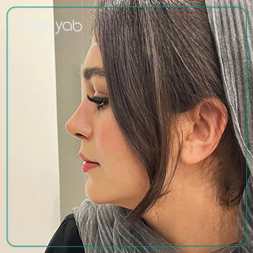 نمونه کار جراحی بینی نیمه فانتزی دکتر پیام حق پناه