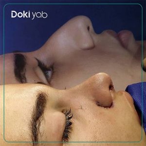 نمونه کار عمل بینی دکتر کاظم رشته احمدی جراح بینی در شیراز