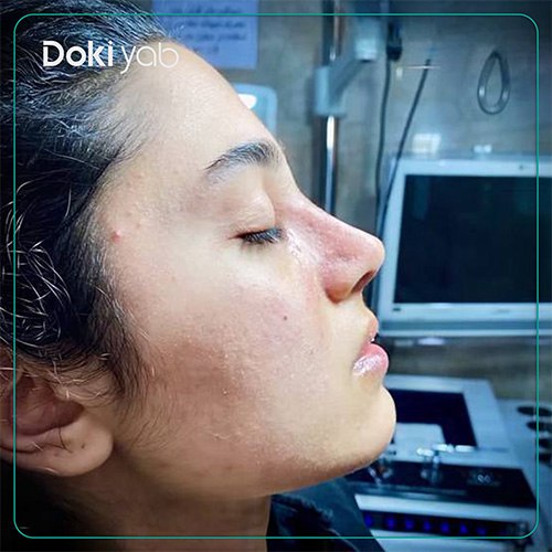 نمونه کار جراحی بینی طبیعی دکتر مسعود جانی پور در شیراز
