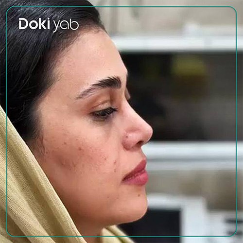 نمونه کار عمل بینی طبیعی دکتر مسعود جانی پور در شیراز