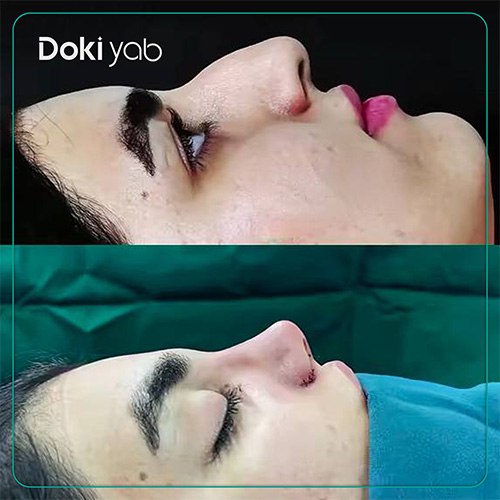 نمونه کار عمل بینی نیمه فانتزی دکتر مسعود جانی پور جراح بینی در شیراز