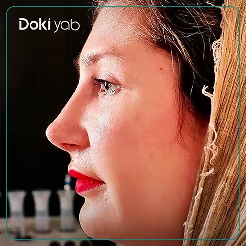 نمونه کار جراحی بینی نیمه فانتزی دکتر مسعود جانی پور جراح بینی در شیراز