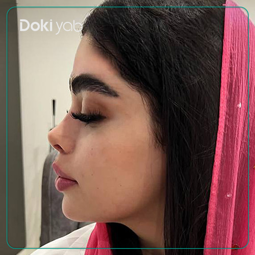 نمونه کار جراحی بینی فانتزی دکتر پیام حق پناه